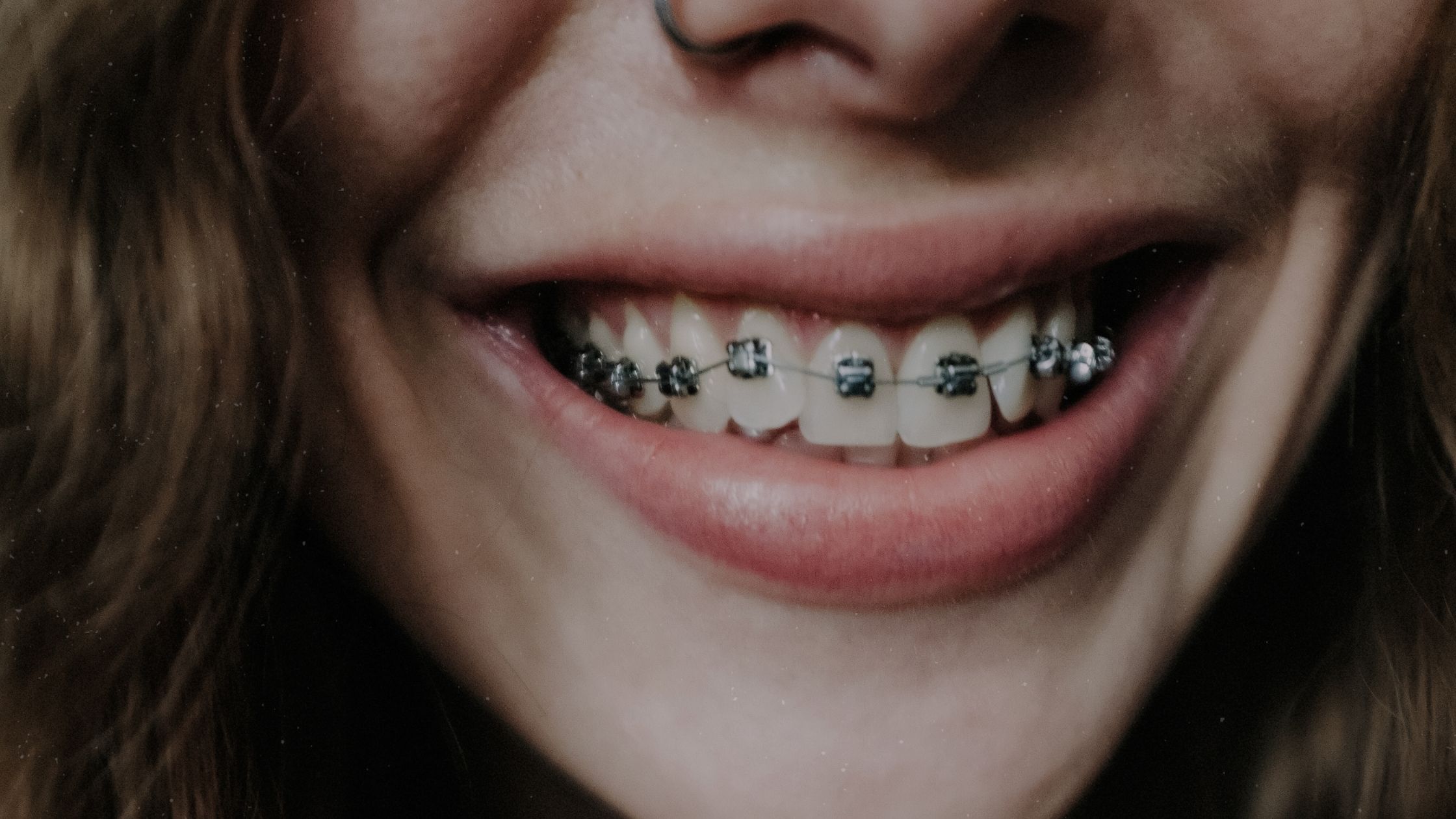 how do braces move teeth