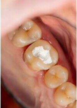 Homemade Temporary Tooth Filling – How To Guide